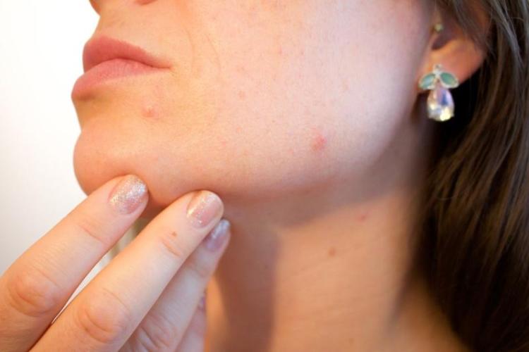 Novel acne treatments